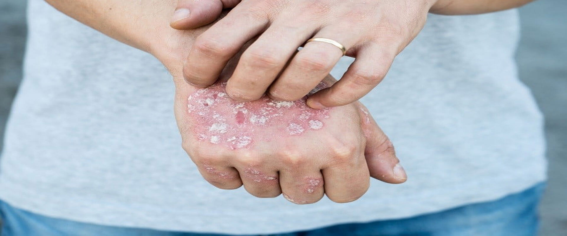 Psoriasis kann mit CBG behandelt werden | 2020| Canbys beste Bio-Produkte